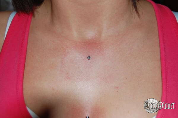 microdermal madison